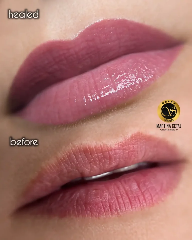 Lip pigmentation shown healed (top, labelled healed) and before treatment (bottom, labelled before)